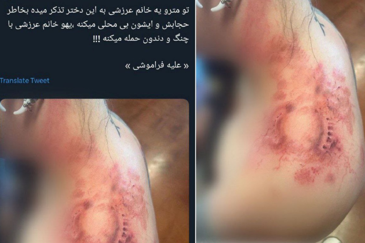 عکس| واقعیت ماجرای گاز گرفتن دختر بی حجاب توسط آمر به معروف در مترو عکس| واقعیت ماجرای گاز گرفتن دختر بی حجاب توسط آمر به معروف در مترو | دیلی 3
